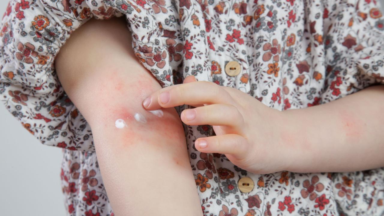 Kūdikių ir vaikų atopinio dermatito gydymas