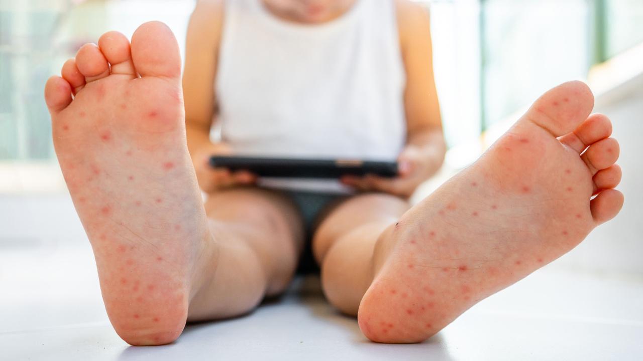 Koksaki virusas, rankų-kojų-burnos liga. Berniuko pėdos išbertos.